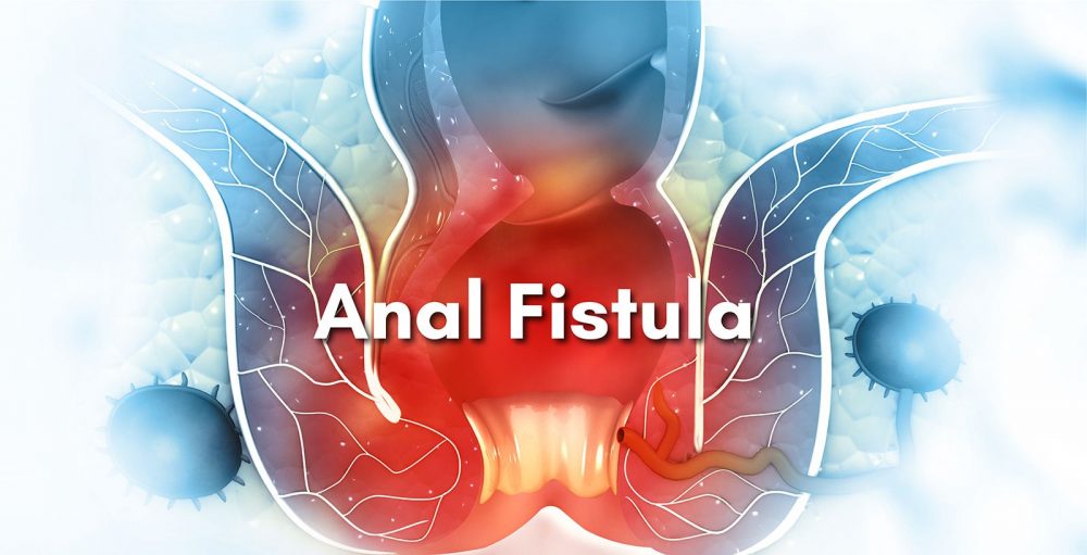 What is an anal fistula?