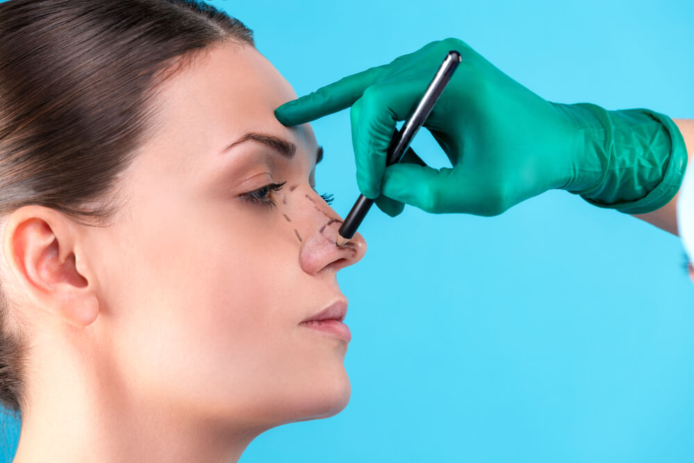 Rhinoplasty