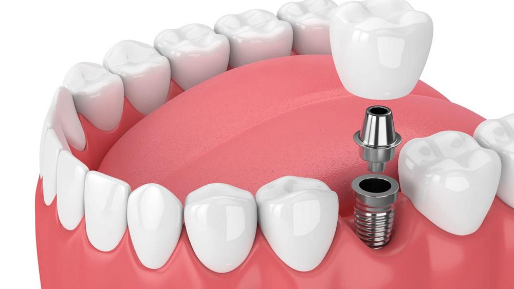 Dental implants in Tehran