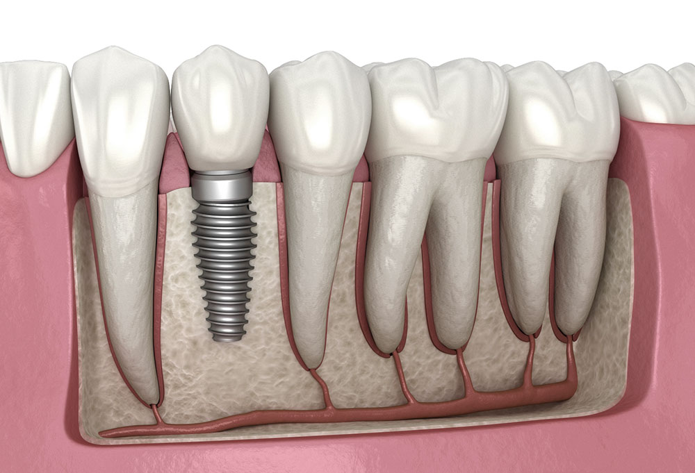 The essential points of dental implant implantation in Mashhad