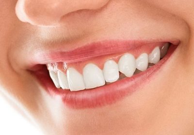 Different methods of smile design correction