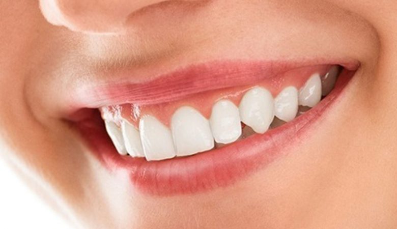 Different methods of smile design correction