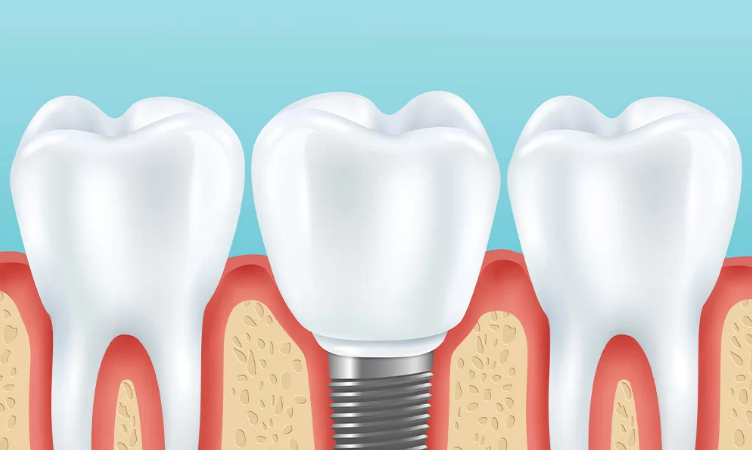 ایمپلنت دندان جایگزینی برای دندانها
