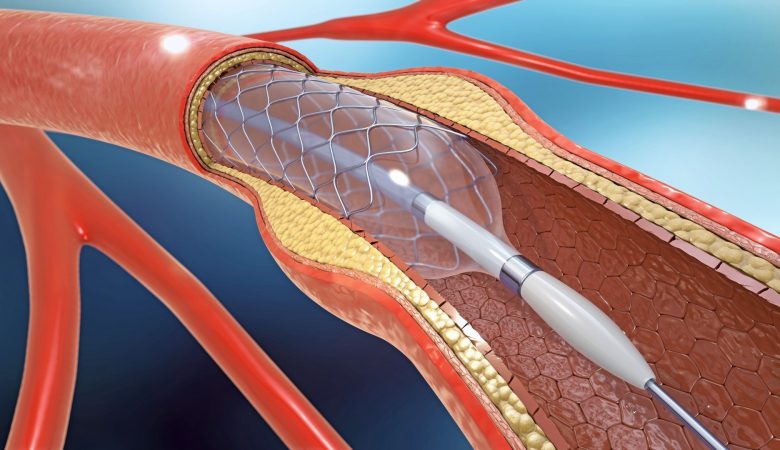 Treatment of narrowing of heart vessels