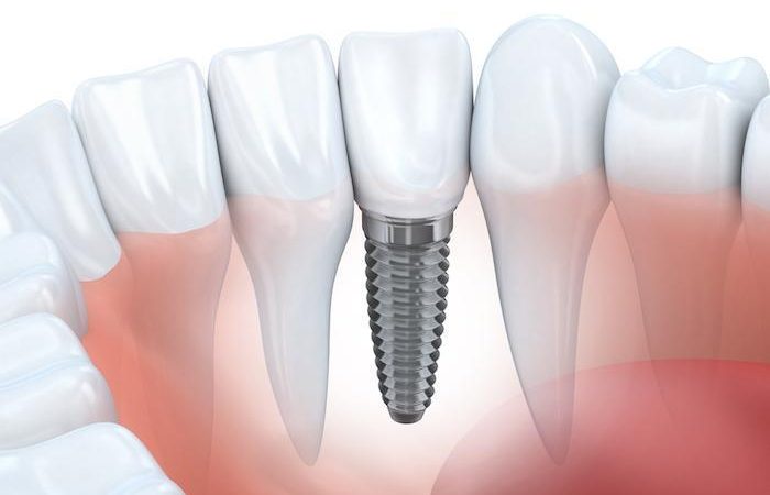 Can all teeth be implanted?