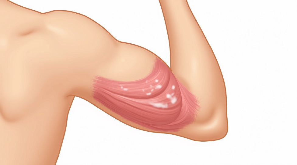 دون دون شدن پشت بازو، از علت تا درمان