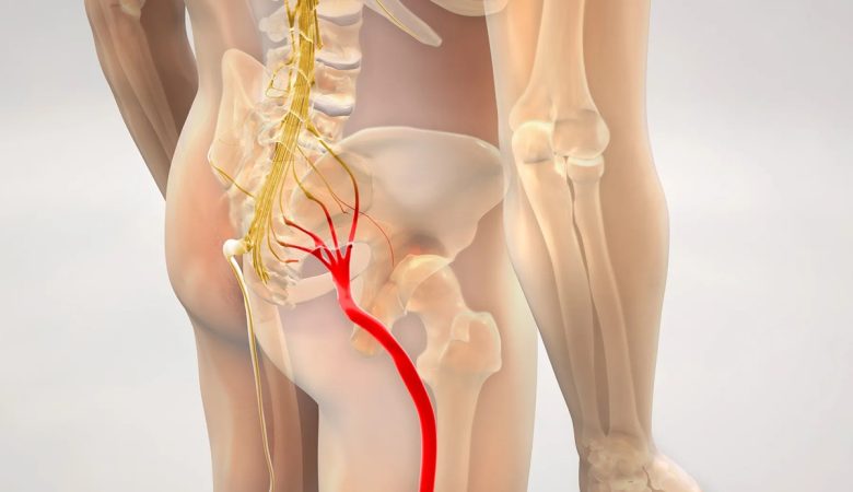 درد سیاتیک چقدر طول می کشد؟ + عوامل موثر در درمان سیاتیک